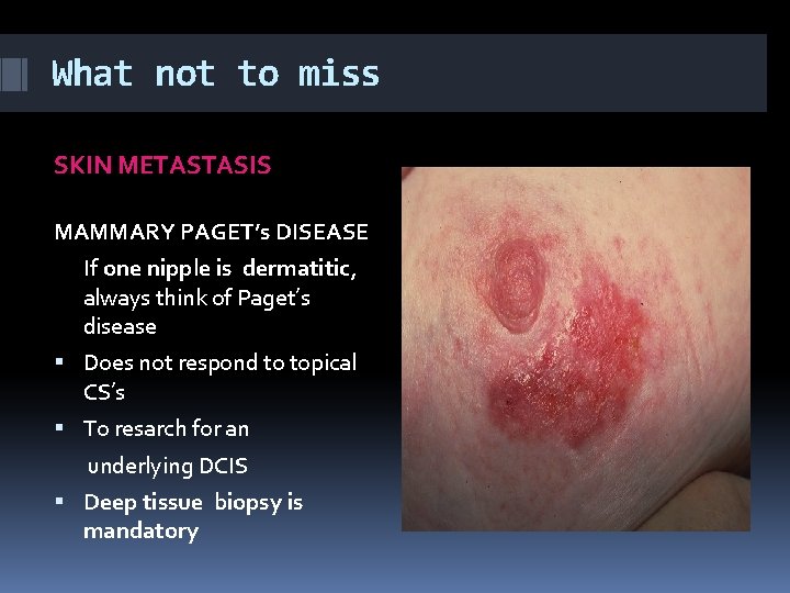 What not to miss SKIN METASTASIS MAMMARY PAGET’s DISEASE If one nipple is dermatitic,