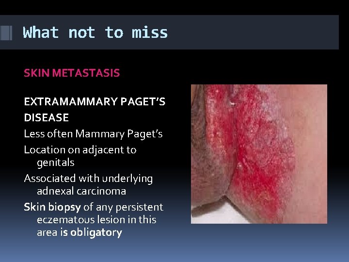What not to miss SKIN METASTASIS EXTRAMAMMARY PAGET’S DISEASE Less often Mammary Paget’s Location