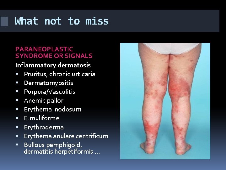 What not to miss PARANEOPLASTIC SYNDROME OR SIGNALS Inflammatory dermatosis Pruritus, chronic urticaria Dermatomyositis