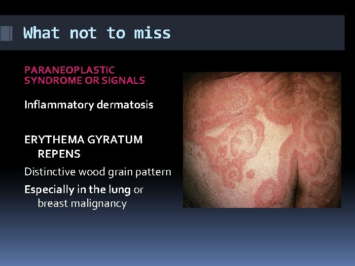 What not to miss PARANEOPLASTIC SYNDROME OR SIGNALS Inflammatory dermatosis ERYTHEMA GYRATUM REPENS Distinctive