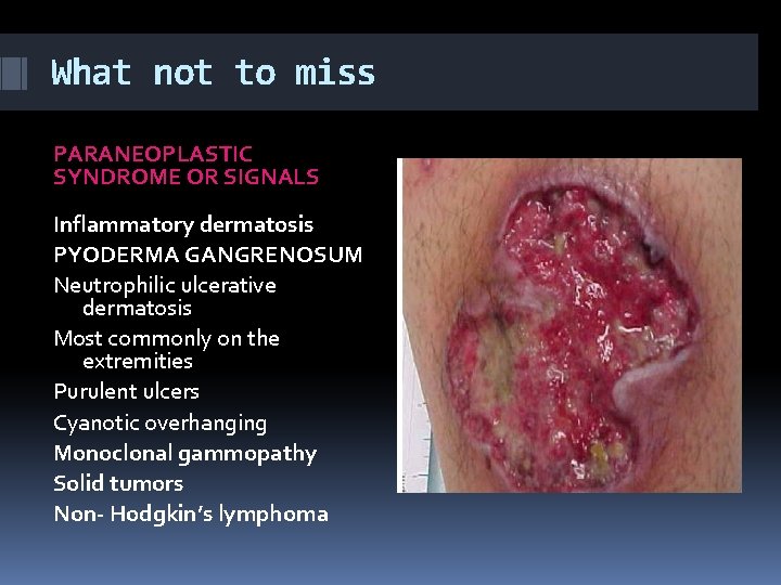 What not to miss PARANEOPLASTIC SYNDROME OR SIGNALS Inflammatory dermatosis PYODERMA GANGRENOSUM Neutrophilic ulcerative