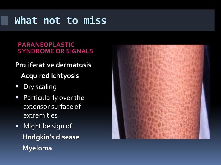 What not to miss PARANEOPLASTIC SYNDROME OR SIGNALS Proliferative dermatosis Acquired Ichtyosis Dry scaling