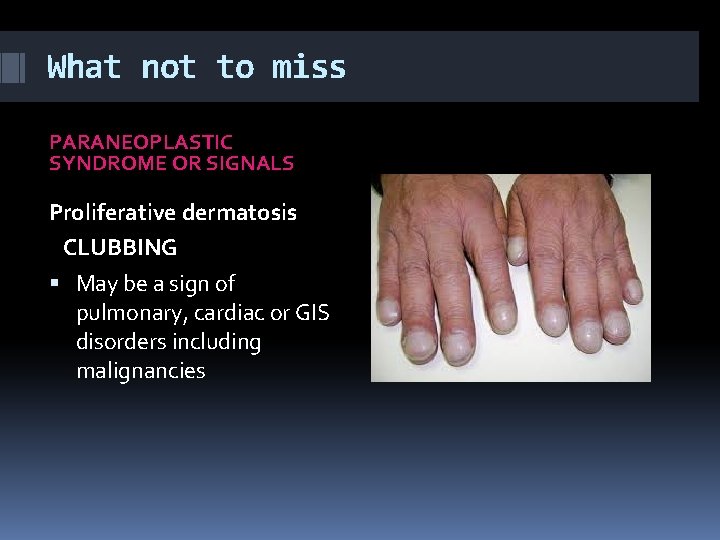 What not to miss PARANEOPLASTIC SYNDROME OR SIGNALS Proliferative dermatosis CLUBBING May be a