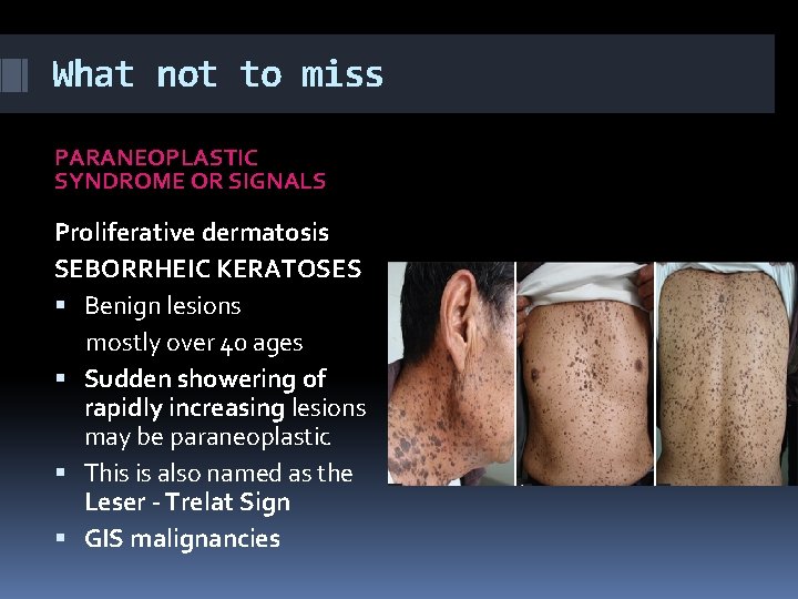 What not to miss PARANEOPLASTIC SYNDROME OR SIGNALS Proliferative dermatosis SEBORRHEIC KERATOSES Benign lesions