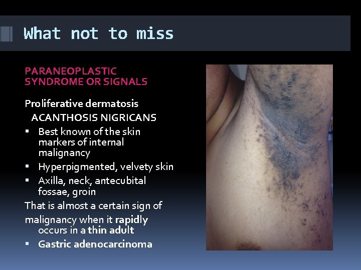 What not to miss PARANEOPLASTIC SYNDROME OR SIGNALS Proliferative dermatosis ACANTHOSIS NIGRICANS Best known