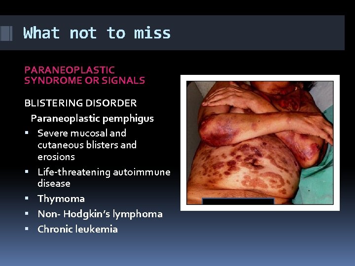 What not to miss PARANEOPLASTIC SYNDROME OR SIGNALS BLISTERING DISORDER Paraneoplastic pemphigus Severe mucosal