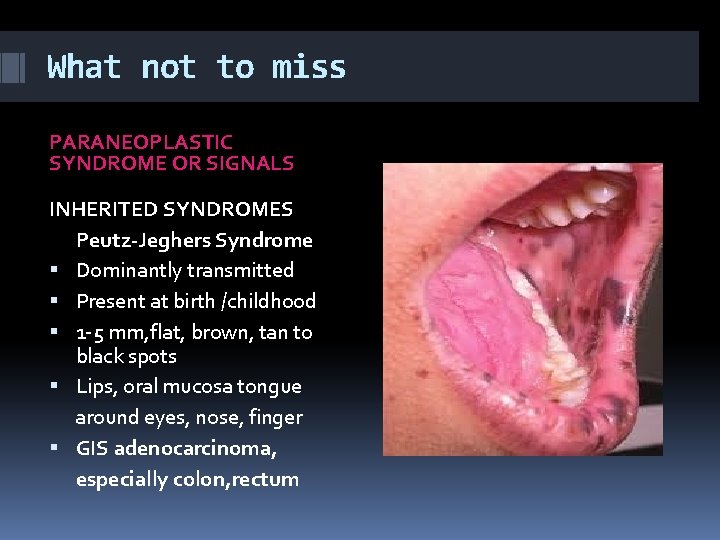 What not to miss PARANEOPLASTIC SYNDROME OR SIGNALS INHERITED SYNDROMES Peutz-Jeghers Syndrome Dominantly transmitted