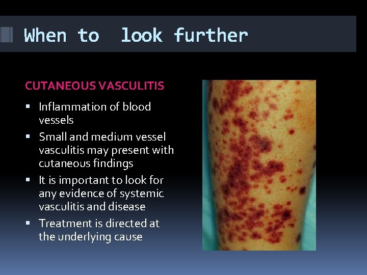 When to look further CUTANEOUS VASCULITIS Inflammation of blood vessels Small and medium vessel