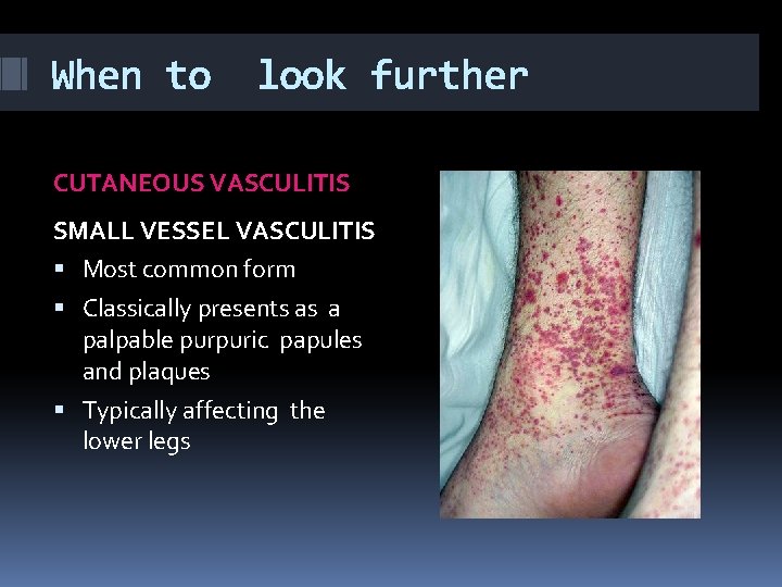 When to look further CUTANEOUS VASCULITIS SMALL VESSEL VASCULITIS Most common form Classically presents