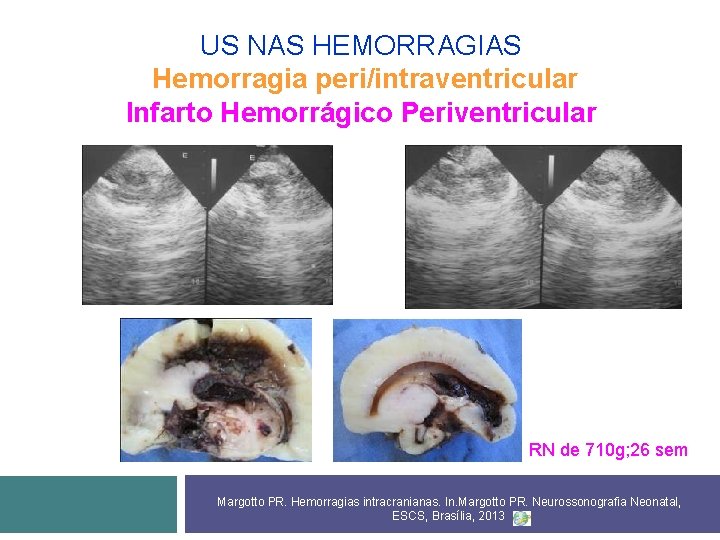 US NAS HEMORRAGIAS Hemorragia peri/intraventricular Infarto Hemorrágico Periventricular RN de 710 g; 26 sem