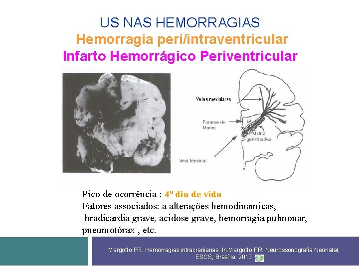 US NAS HEMORRAGIAS Hemorragia peri/intraventricular Infarto Hemorrágico Periventricular Pico de ocorrência : 4º dia