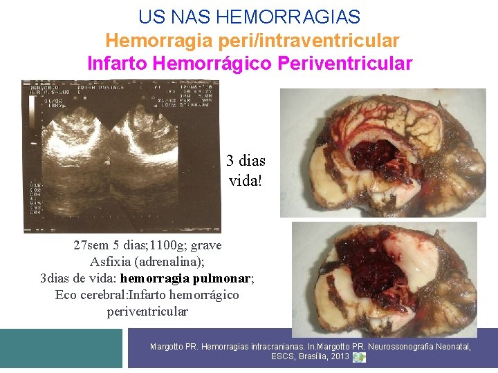 US NAS HEMORRAGIAS Hemorragia peri/intraventricular Infarto Hemorrágico Periventricular 3 dias vida! 27 sem 5