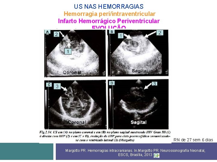 US NAS HEMORRAGIAS Hemorragia peri/intraventricular Infarto Hemorrágico Periventricular EVOLUÇÃO RN de 27 sem 6