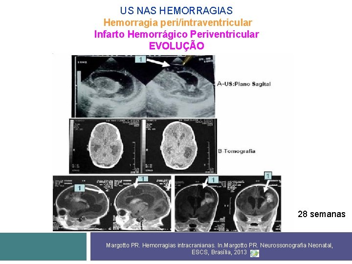 US NAS HEMORRAGIAS Hemorragia peri/intraventricular Infarto Hemorrágico Periventricular EVOLUÇÃO 28 semanas Margotto PR. Hemorragias