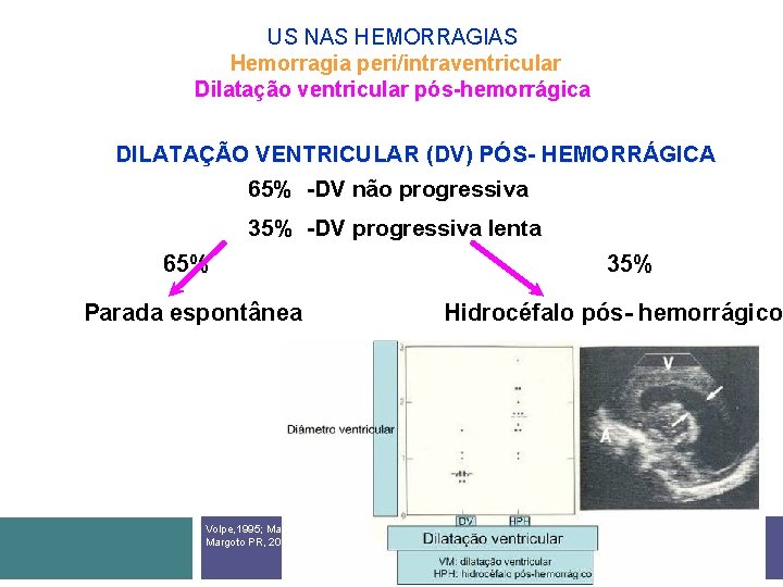 US NAS HEMORRAGIAS Hemorragia peri/intraventricular Dilatação ventricular pós-hemorrágica DILATAÇÃO VENTRICULAR (DV) PÓS- HEMORRÁGICA 65%