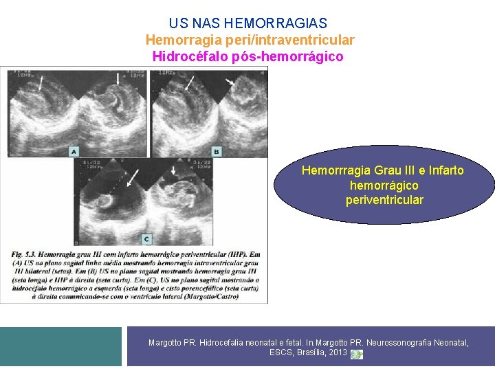 US NAS HEMORRAGIAS Hemorragia peri/intraventricular Hidrocéfalo pós-hemorrágico Hemorrragia Grau III e Infarto hemorrágico periventricular