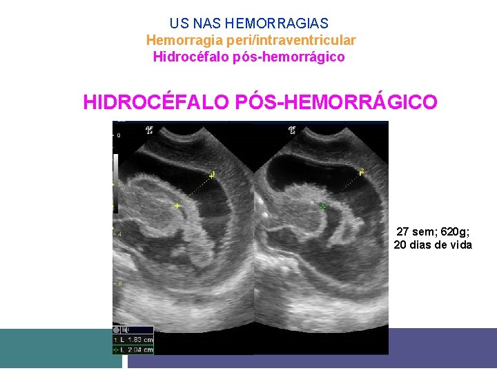 US NAS HEMORRAGIAS Hemorragia peri/intraventricular Hidrocéfalo pós-hemorrágico HIDROCÉFALO PÓS-HEMORRÁGICO 27 sem; 620 g; 20