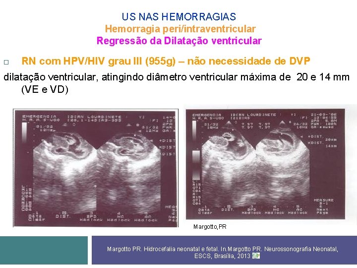 US NAS HEMORRAGIAS Hemorragia peri/intraventricular Regressão da Dilatação ventricular RN com HPV/HIV grau III