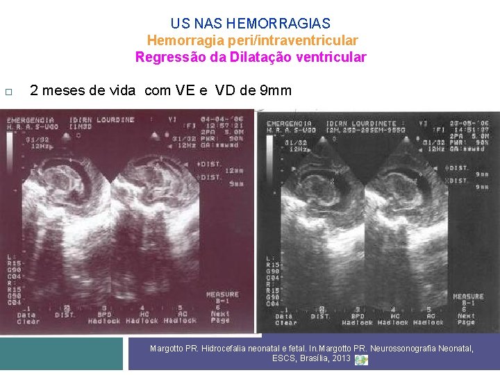 US NAS HEMORRAGIAS Hemorragia peri/intraventricular Regressão da Dilatação ventricular 2 meses de vida com