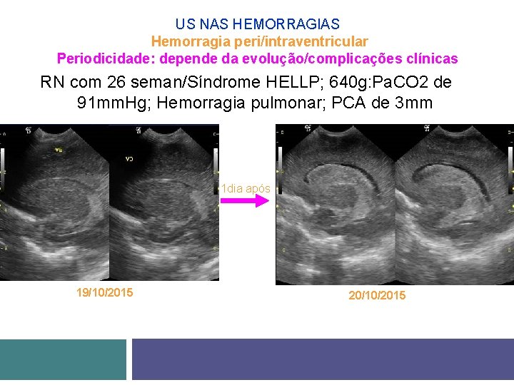 US NAS HEMORRAGIAS Hemorragia peri/intraventricular Periodicidade: depende da evolução/complicações clínicas RN com 26 seman/Síndrome