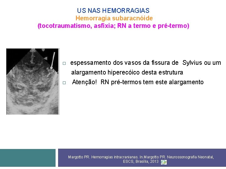 US NAS HEMORRAGIAS Hemorragia subaracnóide (tocotraumatismo, asfixia; RN a termo e pré-termo) espessamento dos