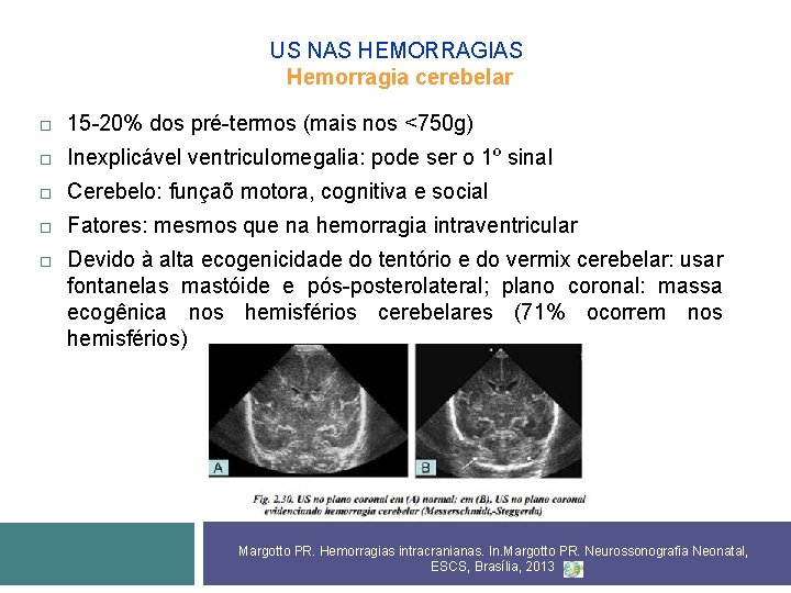 US NAS HEMORRAGIAS Hemorragia cerebelar 15 -20% dos pré-termos (mais nos <750 g) Inexplicável