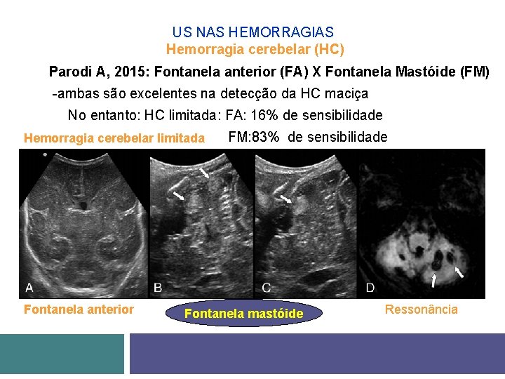 US NAS HEMORRAGIAS Hemorragia cerebelar (HC) Parodi A, 2015: Fontanela anterior (FA) X Fontanela