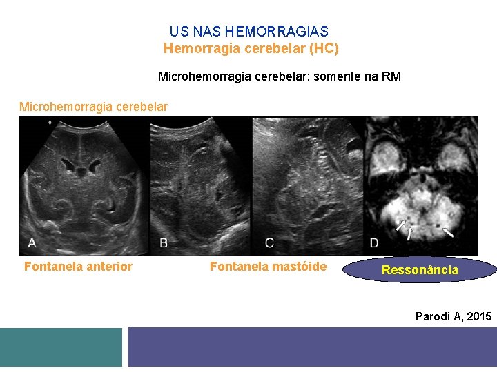 US NAS HEMORRAGIAS Hemorragia cerebelar (HC) Microhemorragia cerebelar: somente na RM Microhemorragia cerebelar Fontanela