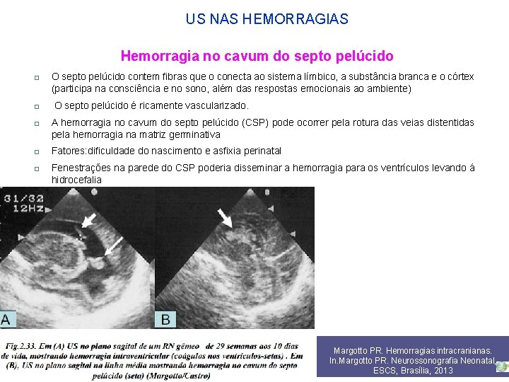 US NAS HEMORRAGIAS Hemorragia no cavum do septo pelúcido O septo pelúcido contem fibras