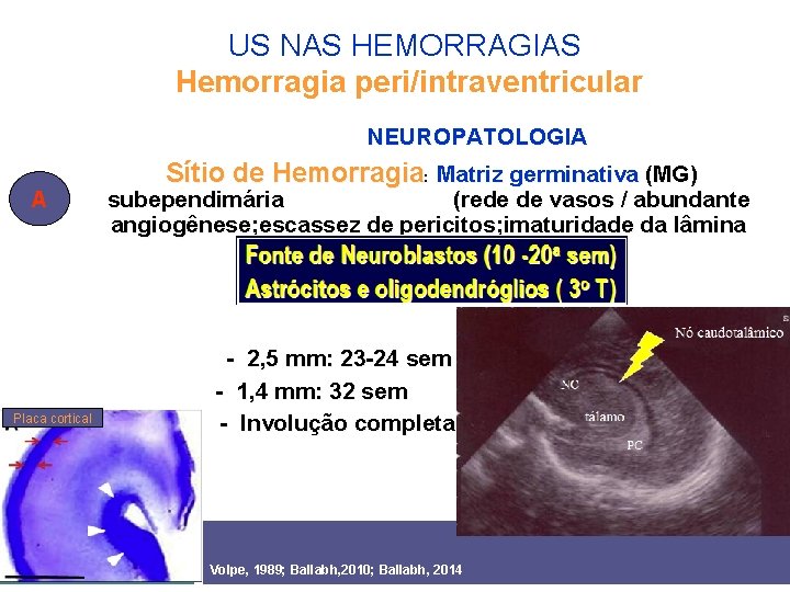 US NAS HEMORRAGIAS Hemorragia peri/intraventricular NEUROPATOLOGIA A Placa cortical Sítio de Hemorragia: Matriz germinativa