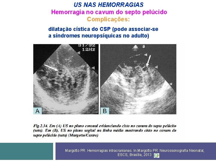 US NAS HEMORRAGIAS Hemorragia no cavum do septo pelúcido Complicações: dilatação cística do CSP