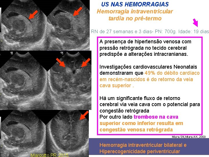 US NAS HEMORRAGIAS Hemorragia intraventricular tardia no pré-termo RN de 27 semanas e 3