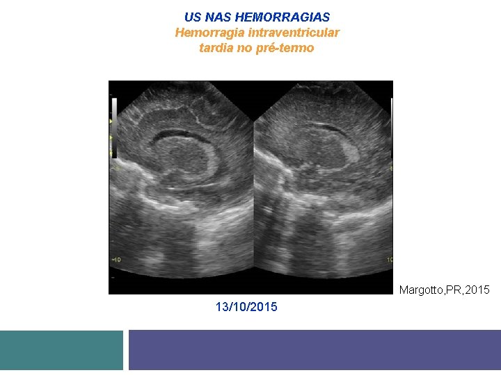 US NAS HEMORRAGIAS Hemorragia intraventricular tardia no pré-termo Margotto, PR, 2015 13/10/2015 