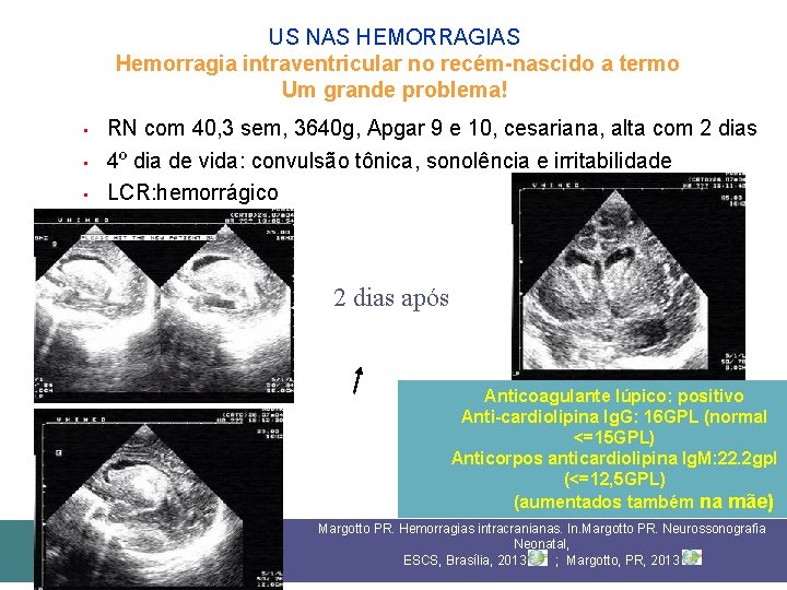 US NAS HEMORRAGIAS Hemorragia intraventricular no recém-nascido a termo Um grande problema! • •