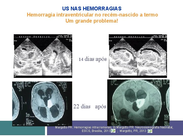 US NAS HEMORRAGIAS Hemorragia intraventricular no recém-nascido a termo Um grande problema! 14 dias