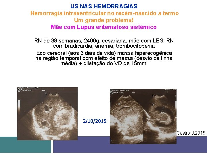 US NAS HEMORRAGIAS Hemorragia intraventricular no recém-nascido a termo Um grande problema! Mãe com