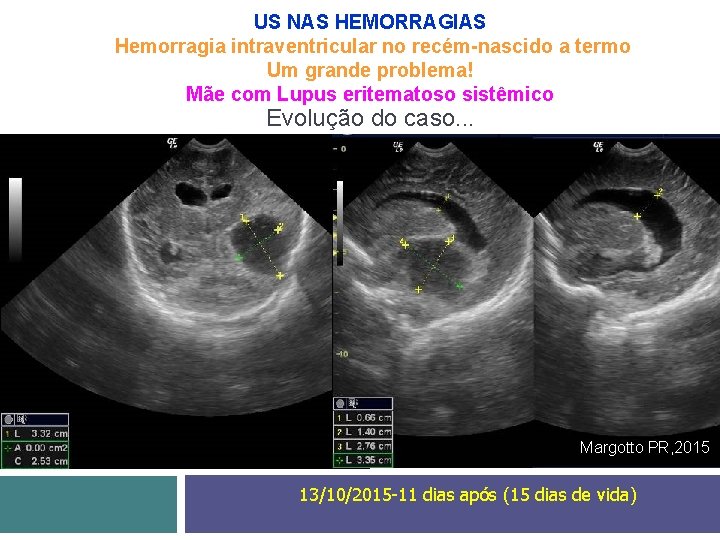 US NAS HEMORRAGIAS Hemorragia intraventricular no recém-nascido a termo Um grande problema! Mãe com