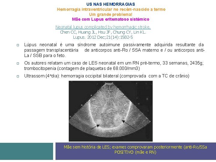 US NAS HEMORRAGIAS Hemorragia intraventricular no recém-nascido a termo Um grande problema! Mãe com