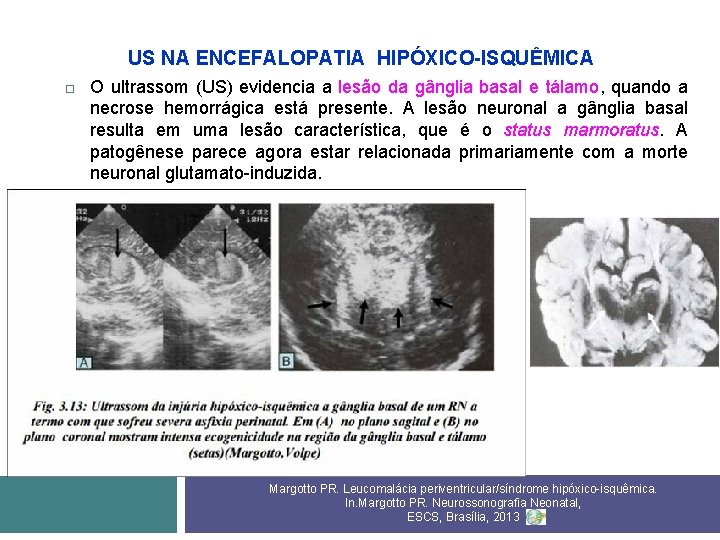 US NA ENCEFALOPATIA HIPÓXICO-ISQUÊMICA O ultrassom (US) evidencia a lesão da gânglia basal e