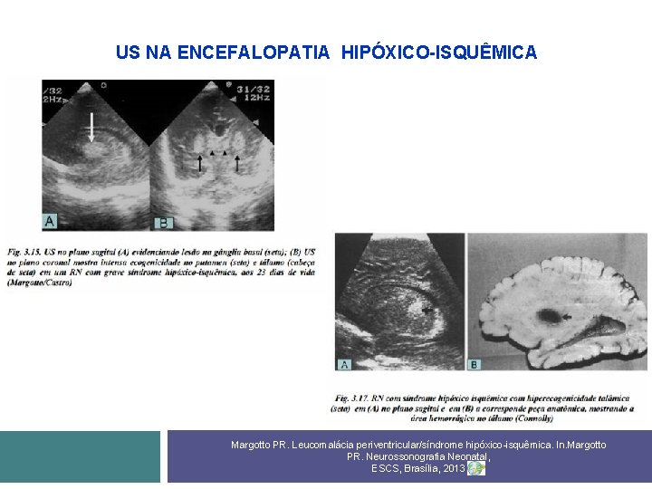 US NA ENCEFALOPATIA HIPÓXICO-ISQUÊMICA Margotto PR. Leucomalácia periventricular/síndrome hipóxico-isquêmica. In. Margotto PR. Neurossonografia Neonatal,