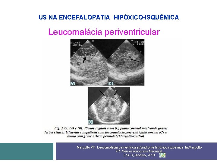 US NA ENCEFALOPATIA HIPÓXICO-ISQUÊMICA Leucomalácia periventricular Margotto PR. Leucomalácia periventricular/síndrome hipóxico-isquêmica. In. Margotto PR.