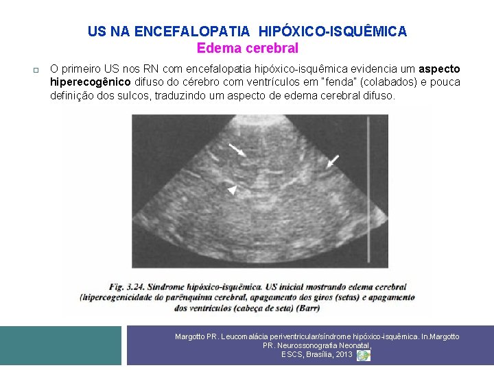 US NA ENCEFALOPATIA HIPÓXICO-ISQUÊMICA Edema cerebral O primeiro US nos RN com encefalopatia hipóxico-isquêmica