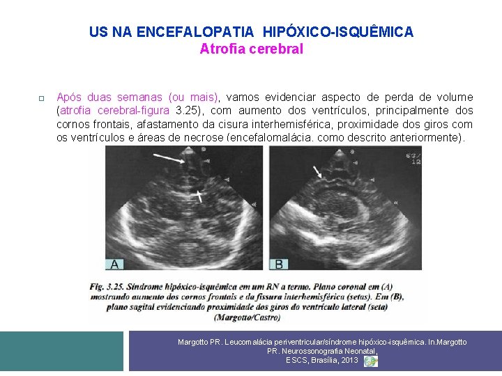 US NA ENCEFALOPATIA HIPÓXICO-ISQUÊMICA Atrofia cerebral Após duas semanas (ou mais), vamos evidenciar aspecto