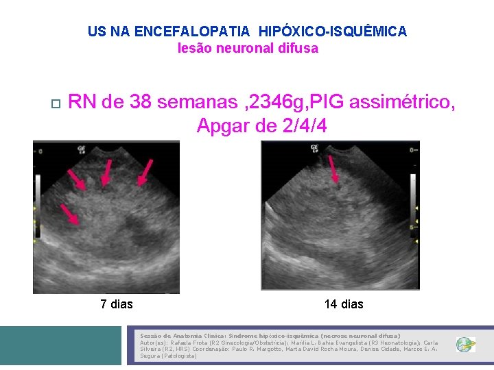 US NA ENCEFALOPATIA HIPÓXICO-ISQUÊMICA lesão neuronal difusa RN de 38 semanas , 2346 g,