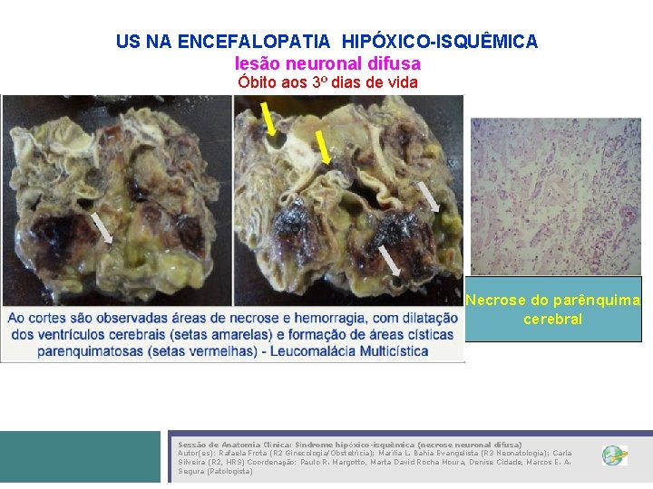 US NA ENCEFALOPATIA HIPÓXICO-ISQUÊMICA lesão neuronal difusa Óbito aos 3º dias de vida Necrose