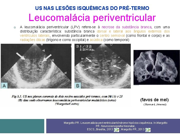 US NAS LESÕES ISQUÊMICAS DO PRÉ-TERMO Leucomalácia periventricular A leucomalácia periventricular (LPV) refere-se à