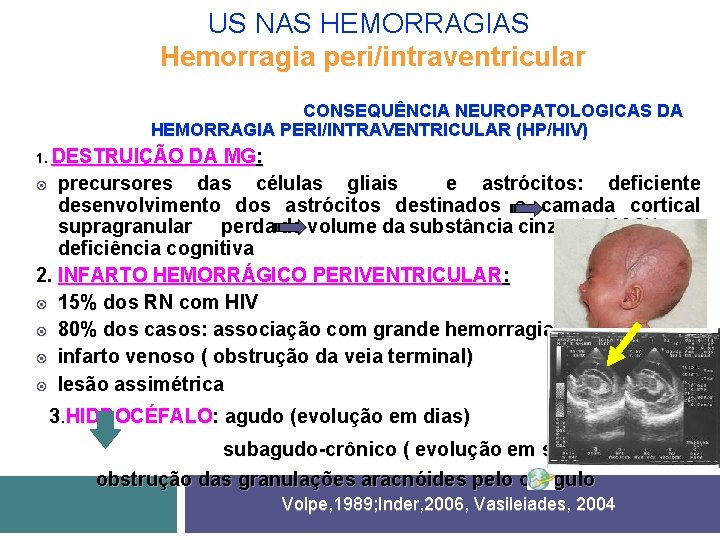 US NAS HEMORRAGIAS Hemorragia peri/intraventricular CONSEQUÊNCIA NEUROPATOLOGICAS DA HEMORRAGIA PERI/INTRAVENTRICULAR (HP/HIV) 1. DESTRUIÇÃO DA