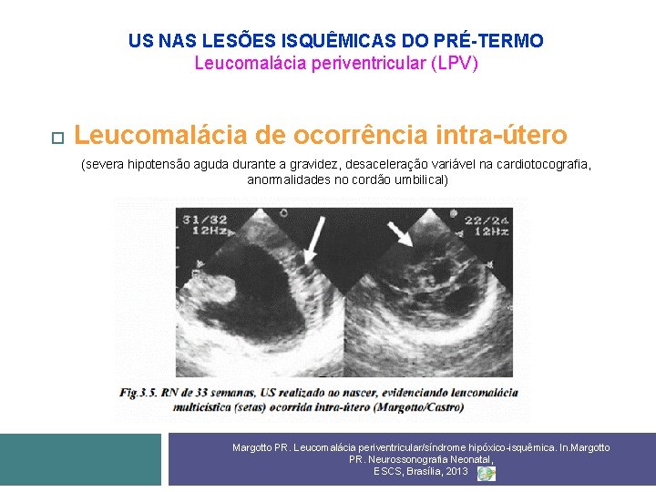 US NAS LESÕES ISQUÊMICAS DO PRÉ-TERMO Leucomalácia periventricular (LPV) Leucomalácia de ocorrência intra-útero (severa