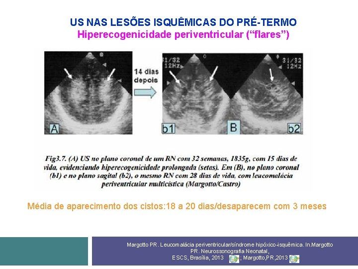 US NAS LESÕES ISQUÊMICAS DO PRÉ-TERMO Hiperecogenicidade periventricular (“flares”) Média de aparecimento dos cistos: