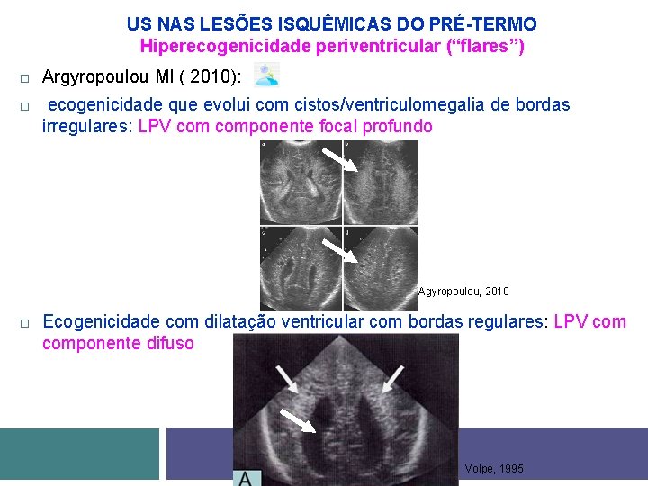 US NAS LESÕES ISQUÊMICAS DO PRÉ-TERMO Hiperecogenicidade periventricular (“flares”) Argyropoulou MI ( 2010): ecogenicidade